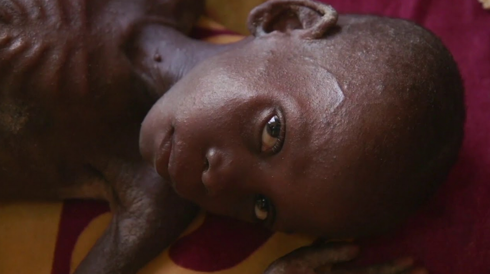 Criança desnutrida em estado grave