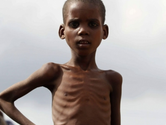 Criança com desnutrição severa