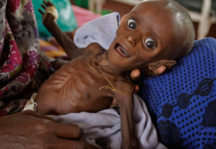 Bebê severamente desnutrido